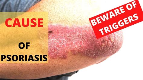 😲 ¿what Is The Cause Of Psoriasis Triggers Of Psoriasis Youtube