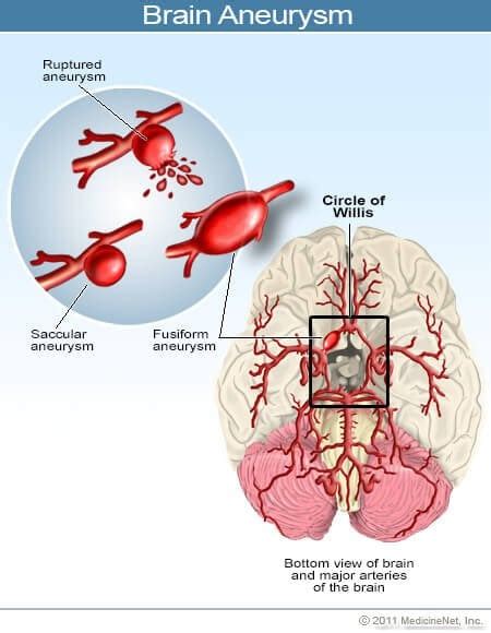Brain Aneurysm Symptoms Causes Definition And Treatment