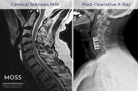 Cervical Stenosis With Myelopathy Modern Orthopedic Spine Specialists