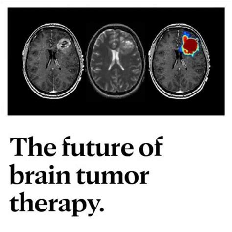 Mayo Clinic New Brain Tumor Treatments