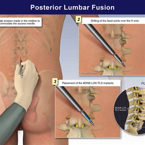 Posterior Lumbar Fusion Trialexhibits Inc