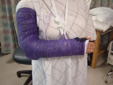 Management - Spiral humeral fracture