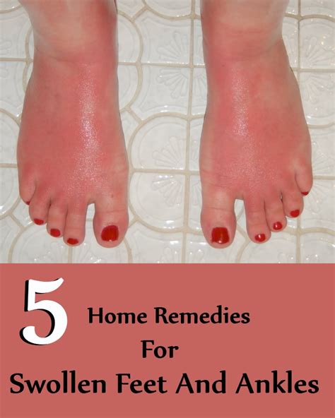 5 Home Remedies For Swollen Feet And Ankles Search Home Remedy