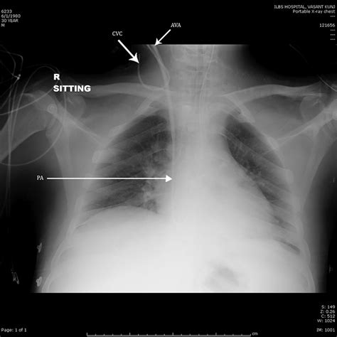 Postoperative Chest Radiograph Showing Malpositioned Central Venous
