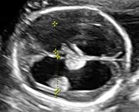 Fetal Ventriculomegaly American Journal Of Obstetrics And Gynecology