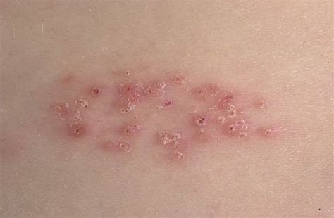 Take action and take back control. Mild Herpes | symptoms & signs, treatment, pictures