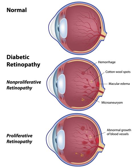 Stages Of Diabetic Retinopathy Apollo Sugar Clinics