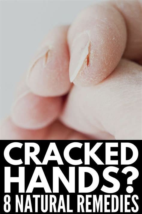Severely Cracked Hands 8 Tips And Remedies For Fast Relief Cracked
