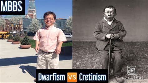 Dwarfism 🆚 Cretinism Differences Mbbs Neetpg Youtube