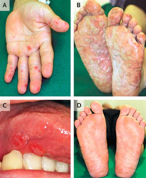 Rash On Palms And Soles Pictures