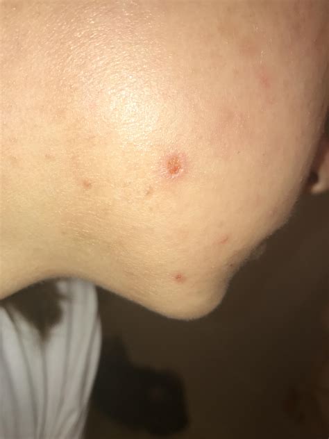 Help Picked Scab Too Soon Hole On Cheek General Acne Discussion