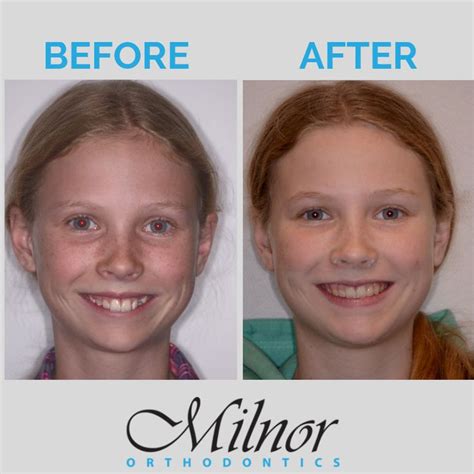 Braces Before And After Orthodontics Invisalign Orthodontics Braces