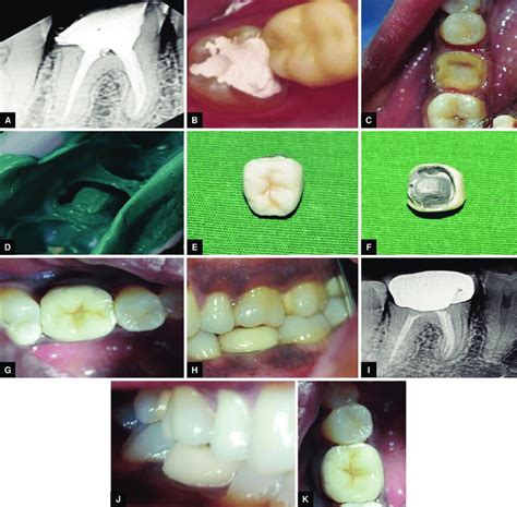 A To J Case 2—metal Ceramic Based Pfm Endocrown Prosthesis A