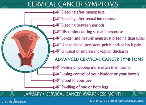Cervical Cancer Symptoms Infographic Vector Illustration