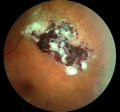 Retinal Hemangiomas American Academy Of Ophthalmology