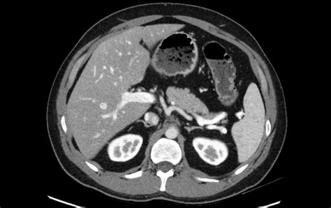 Abdominal Ct Spleen And Adrenal Glands • Litfl • Radiology
