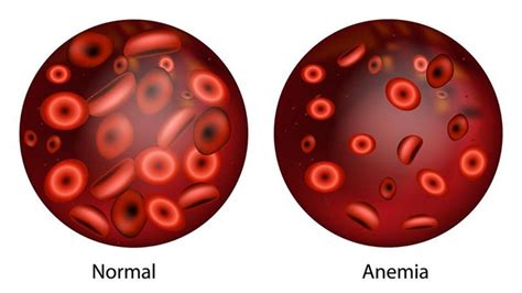 Qué es la anemia Síntomas causas y cómo tratar la enfermedad