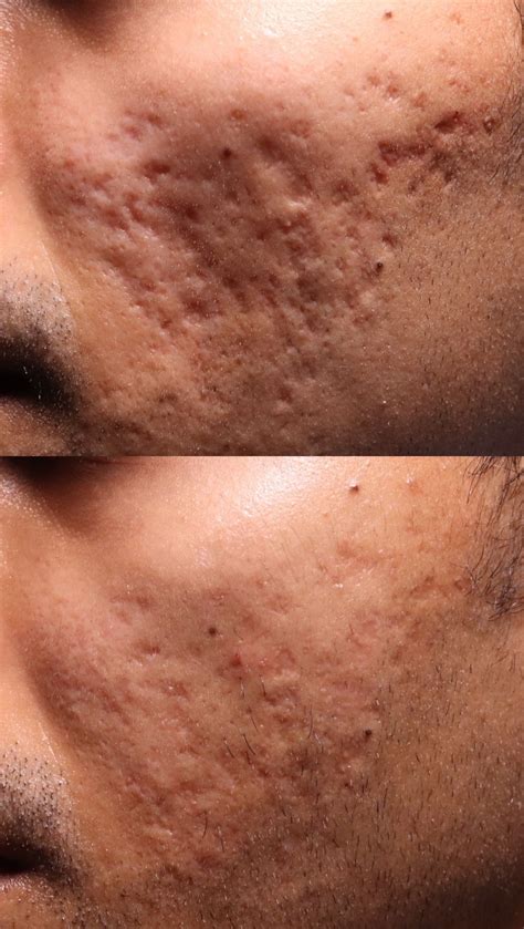 Beforeafter Excellent Results At Scar Healing Institute Beverly