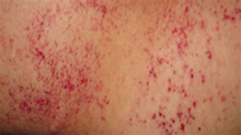 When To Worry About A Rash In Adults Page 4 Of 15 Healthella
