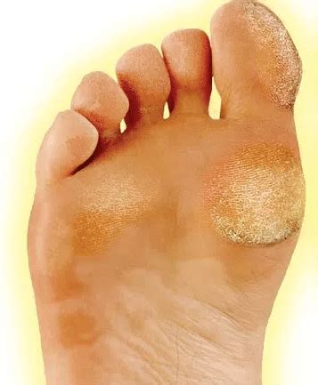 To prevent athlete's foot, allow your running shoes to dry out thoroughly between runs. Bumps on Bottom of Feet under Skin, Lump, Hurts, Toes ...