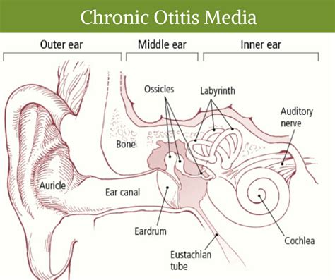 Chronic Otitis Media Treatment In Delhi Surgery Cost Adventis