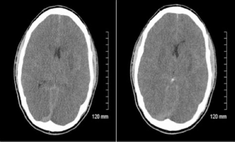 Anoxic Brain Injury Ct And Mri Patterns Quick Pictoral Quide For