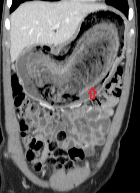 Ct Scan Showing A Low‐density Intragastric Mass Which Contains Air