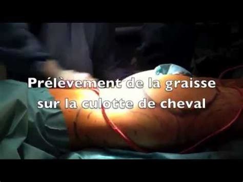 La chirurgie esthétique de la silhouette vous apporte la solution : lipofilling fesses , injection de graisse dans les fesses ...