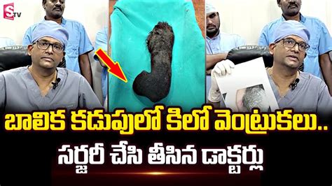 Doctors Removed 2kg Hairs From Womens Stomach Hair Ball Womans