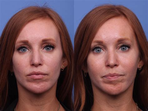 Cheek Implant Before And After Photo Gallery Scottsdale Az Hobgood