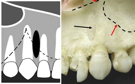 Maxillary Canines Cuspids Radiographic Landmarks Denteach