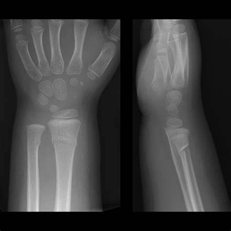 Buckle Fracture Pacs