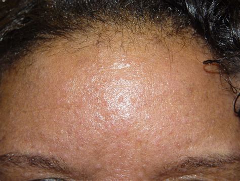 Sebaceous Gland Hyperplasia Pictures Photos