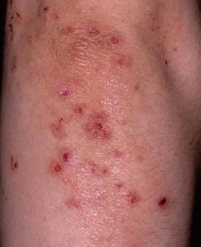 Pictures Of Skin Rashes On Lower Legs A Skin Rash On One Lower