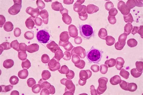 Causes And Treatment Of Low Lymphocyte Count Lymphocytopenia