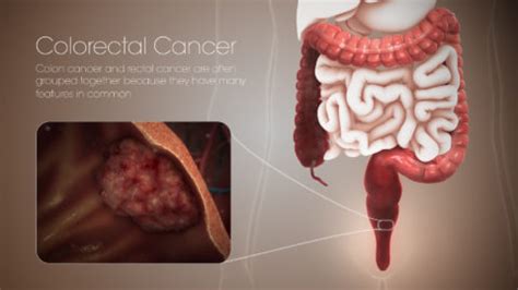 Colorectal Cancer Scientific Animations
