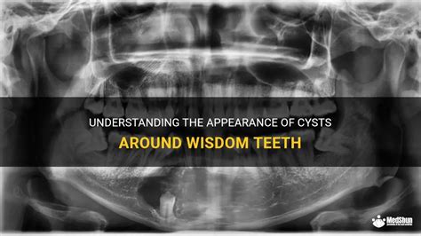 Understanding The Appearance Of Cysts Around Wisdom Teeth Medshun