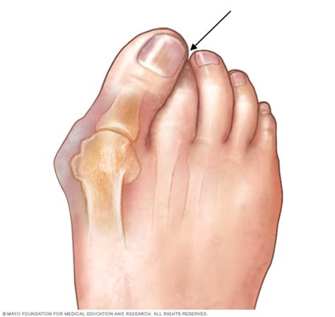 How Do You Know You Have Bunions Feetcare