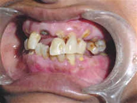 Abfraction lesions are losses of tooth structure. Dental Abfraction
