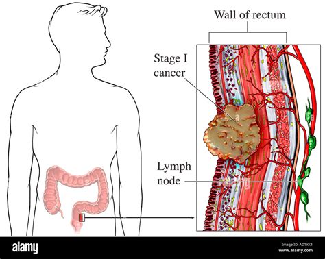 Rectal Cancer Hi Res Stock Photography And Images Alamy
