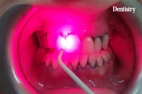 Safe And Effective Photodynamic Therapy Dentistry Co Uk