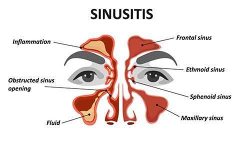 Expert Sinusitis Treatment In Houston Tx Texas Sinus Snoring