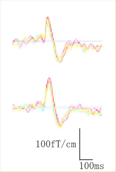 Typical Waveform Of Auditory Evoked Magnetic Fileds From 122 Channels