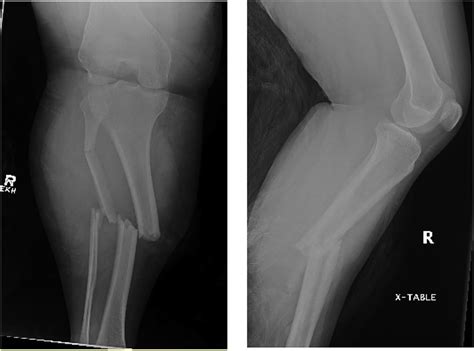Initial Ap And Lateral Radiograph Of The Tibial Midshaft Fracture