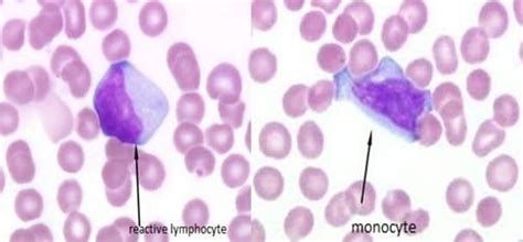 Monocyte And Reactive Lymphocyte Medical Laboratory Medical Lab