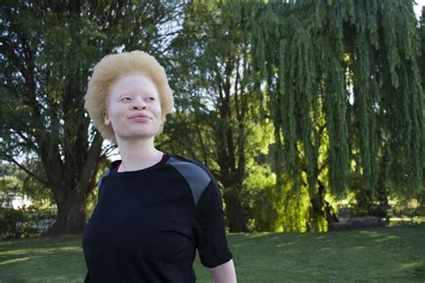 Albinizm Co To Jest Jakie S Przyczyny Albinizmu Jak Wygl Da