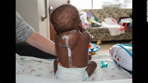 Risky Surgery Separates 10 Month Old From Parasitic Twin Cnn