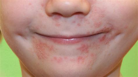 Treat The Pimples Around Mouth All To Health