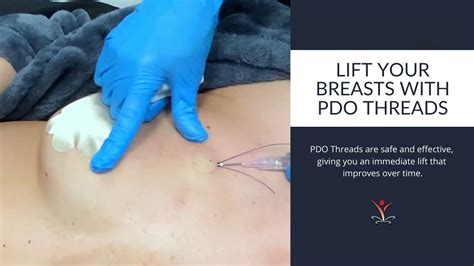 Want Lift Without An Increase In Breast Size Get The Pdo Thread Lift