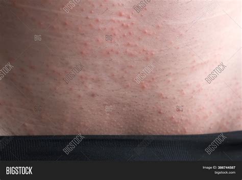 Rash On Skin Man Groin Image And Photo Free Trial Bigstock